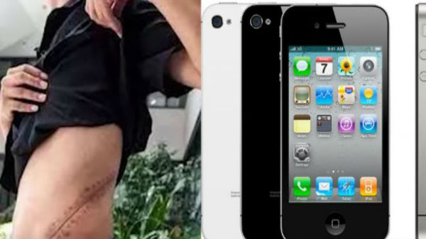 కిడ్నీ తొలగించేటప్పుడు చేసిన చికిత్స విజయవంతం కాలేదు...