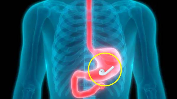 Apple AirPods మింగేశాడు, ఆ తర్వాత ఏం జరిగిందంటే ?